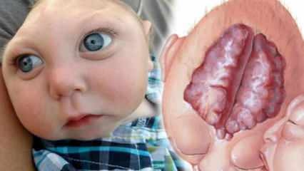 Co to jest bezmózgowie? Jakie są objawy anencefalii u niemowląt i dzieci? Anencefalia powoduje ...