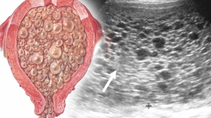 Czym jest ciąża molowa (ciąża winogronowa), jakie są objawy? Jak zrozumieć ciążę molową?