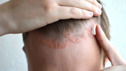 Jakie są objawy łojotokowego zapalenia skóry i kto się pojawia? Pokarmy, które wywołują chorobę