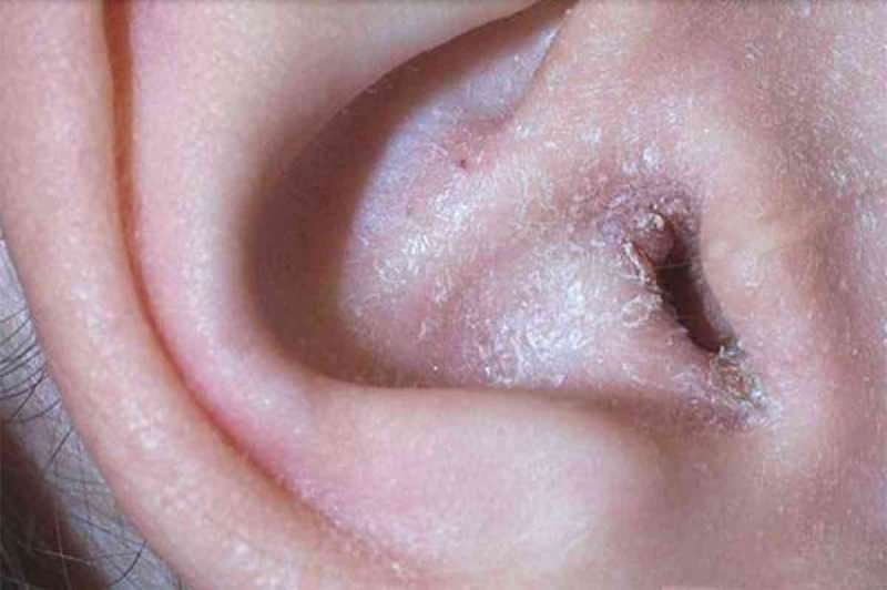 Co powoduje łuszczenie się za uchem i jak mija? Ostateczne rozwiązanie w przypadku egzemy zausznej ...