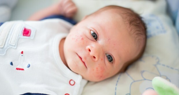 Jak trądzik przechodzi na twarz dziecka? Metody suszenia trądziku (Milia)