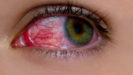 Co powoduje alergię oka? Jakie są objawy alergii oka? Co jest dobre w przypadku alergii oka? 