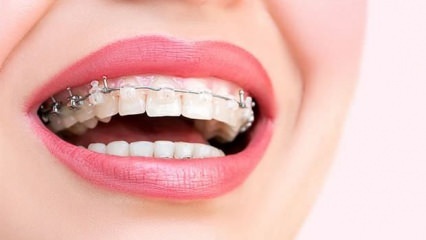 Dlaczego przymocowane są szelki? Jakie są rodzaje aparatów ortodontycznych?