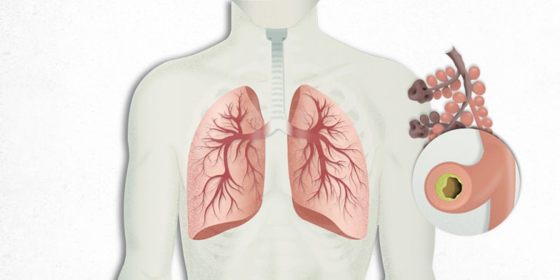 wirus osadzający się w płucach miesza się z zapaleniem płuc