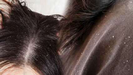 Jak mija łupież i co jest dobre na włosy z łupieżem? 5 najszybszych i najskuteczniejszych metod usuwania łupieżu