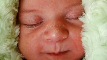 Dlaczego białe kropki pojawiają się u niemowląt?