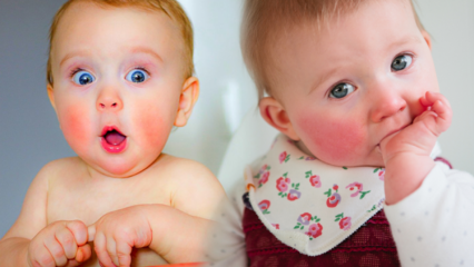 Uwaga u niemowląt z czerwonymi policzkami! Syndrom policzków i jego objawy