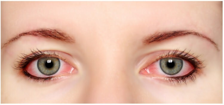 Czy tusz do rzęs i eyeliner wywołują alergię w oczach?