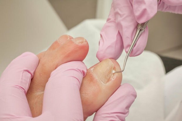 Co powoduje wrastanie paznokci u nóg i jakie są objawy? Naturalne sposoby, które są dobre dla wrastających paznokci ...