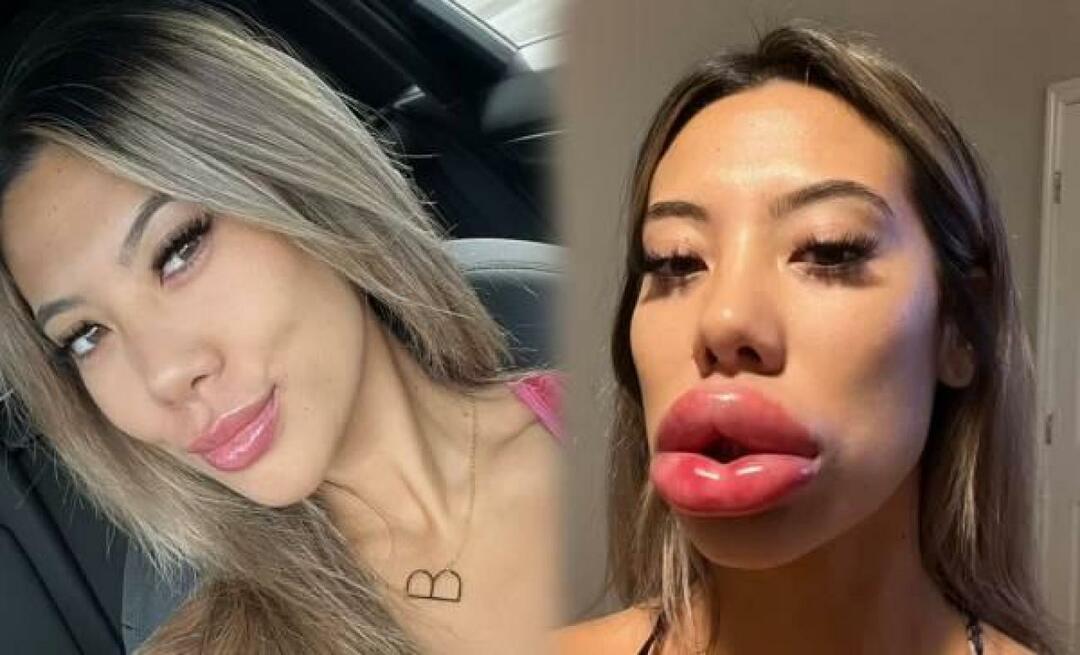 Usta kobiety, która miała wypełniacze w USA, były oszołomione!