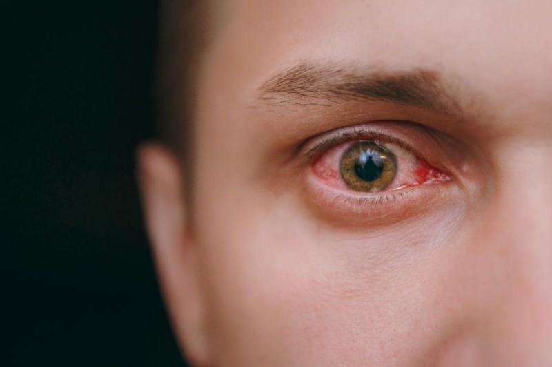 objawy podlewania oczu, krwawienia i swędzenia koronawirusa