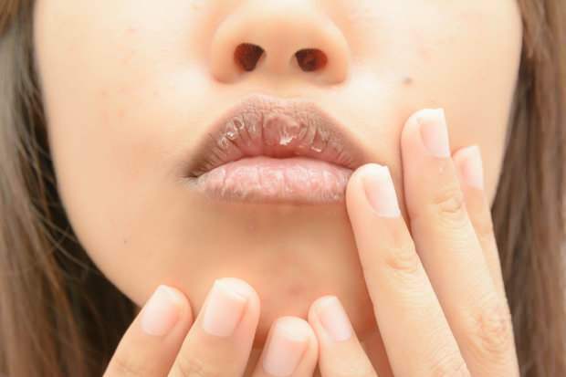 anemia powoduje suchość ust