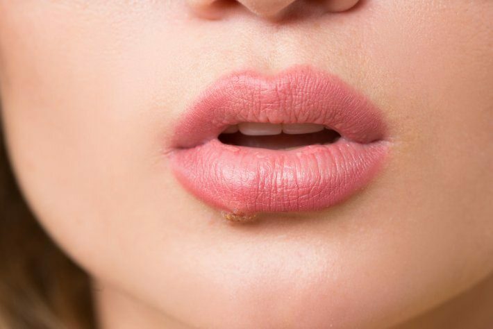 Co to jest rak języka? Jakie są objawy?