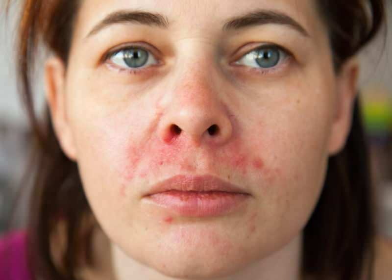 Dlaczego trądzik pojawia się wokół wargi? Jak leczy się zapalenie skóry wokół oczu?