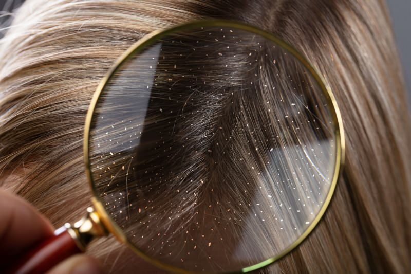 Jak mija łupież i co jest dobre na włosy z łupieżem? 5 najszybszych i najskuteczniejszych środków na łupież