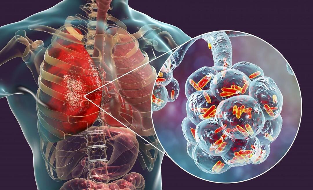 Co to jest zapalenie płuc i jakie są jego objawy? Jak leczy się nowy epidemiczny wirus zapalenia płuc?