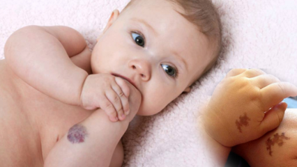 Powoduje znamię u niemowląt, czy jest trwałe? Jakie są rodzaje znamion? Lekarstwo z Saracoglu