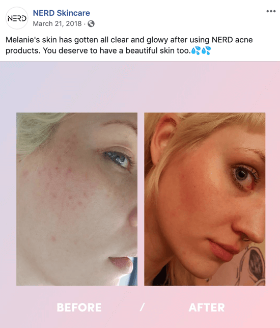 Przykład tego, jak firma Nerd Skincare wykorzystała zdjęcie przed i po, aby utworzyć post ze zdjęciem do mediów społecznościowych, który napędza zakupy ich produktów.