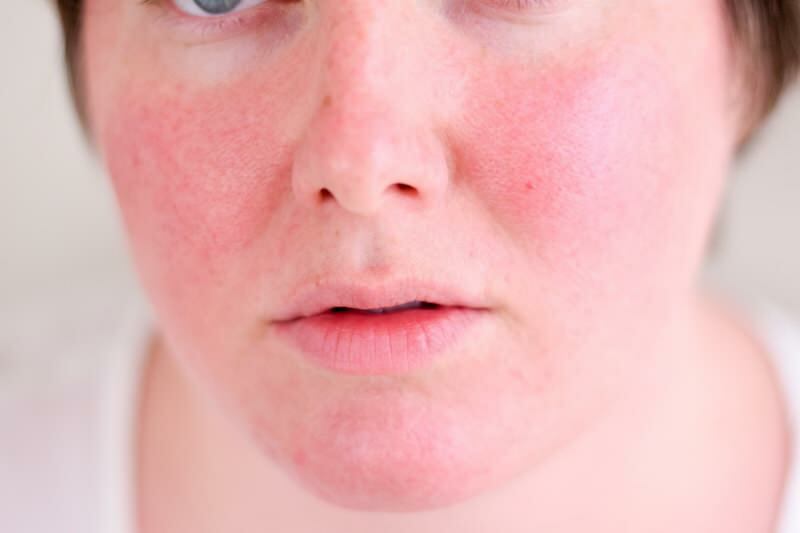 Jak przechodzi zaczerwieniona twarz? Najlepsze produkty do pielęgnacji przeciw zaczerwienieniu twarzy