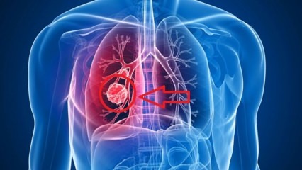 Objawy raka płuc: stadia raka płuc!