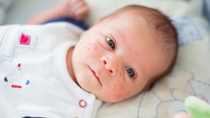 W jaki sposób pryszcze przechodzą na twarz dziecka? Metody suszenia trądziku (Milia)