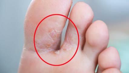 Co to jest grzyb stóp? Jakie są objawy stopy sportowca? Leczenie stopy sportowca 
