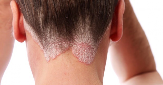 Objawy i leczenie łojotokowego zapalenia skóry