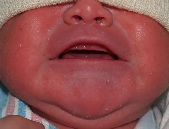 Dlaczego biała plamka pojawia się u niemowląt?