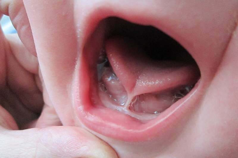 Objawy i leczenie wiązania języka u niemowląt