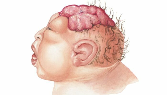 Co to jest bezmózgowie? Jakie są objawy anencefalii u niemowląt i dzieci? Anencefalia powoduje ...