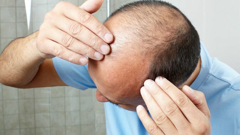Czy przeszczep włosów zapobiega powstawaniu ghusl?