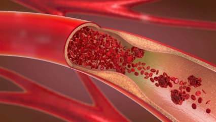 Co to jest anemia (anemia)? Ciągłe osłabienie wskazuje na anemię! Pokarmy dobre na anemię ...