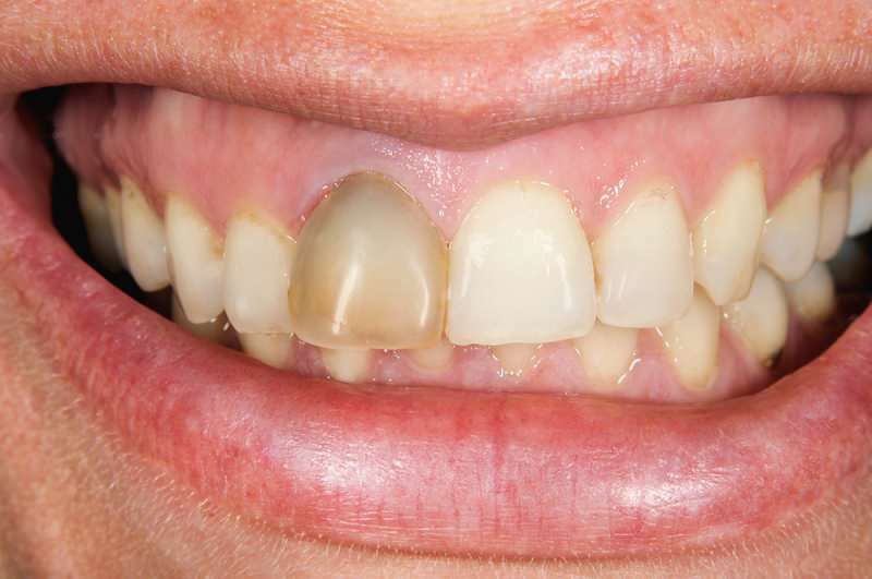 ciemnienie zębów może czasami koncentrować się na jednym zębie