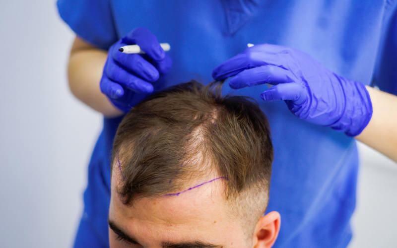 Czy dopuszczalny jest przeszczep włosów w leczeniu wypadania włosów? Co to są włosy protetyczne? Czy włosy protetyczne kolidują z guslem?