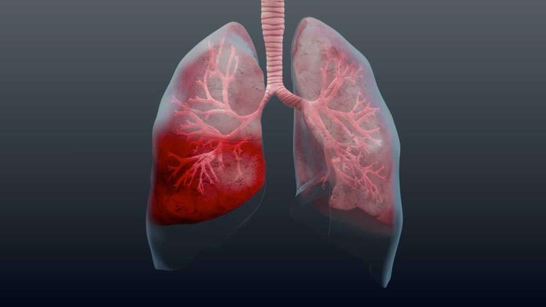 Co to jest zapalenie płuc i jakie są jego objawy? Jak leczy się nowy epidemiczny wirus zapalenia płuc?