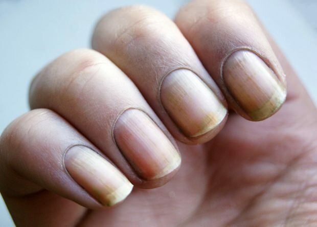 Dlaczego paznokieć zmienia kolor na żółty? Jak wybielić paznokcie, które żółkną od lakieru do paznokci?