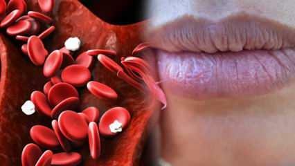 Co to jest anemia? Ciągłe osłabienie jest oznaką anemii! Pokarmy dobre na anemię...