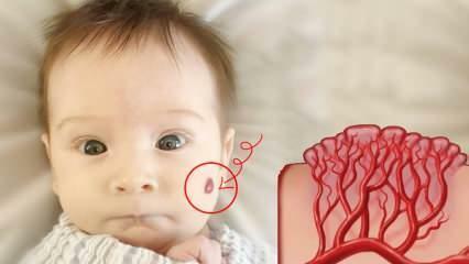 Co to jest znamię naczyniaka krwionośnego? Co powoduje naczyniaka krwionośnego, jakie jest jego leczenie?