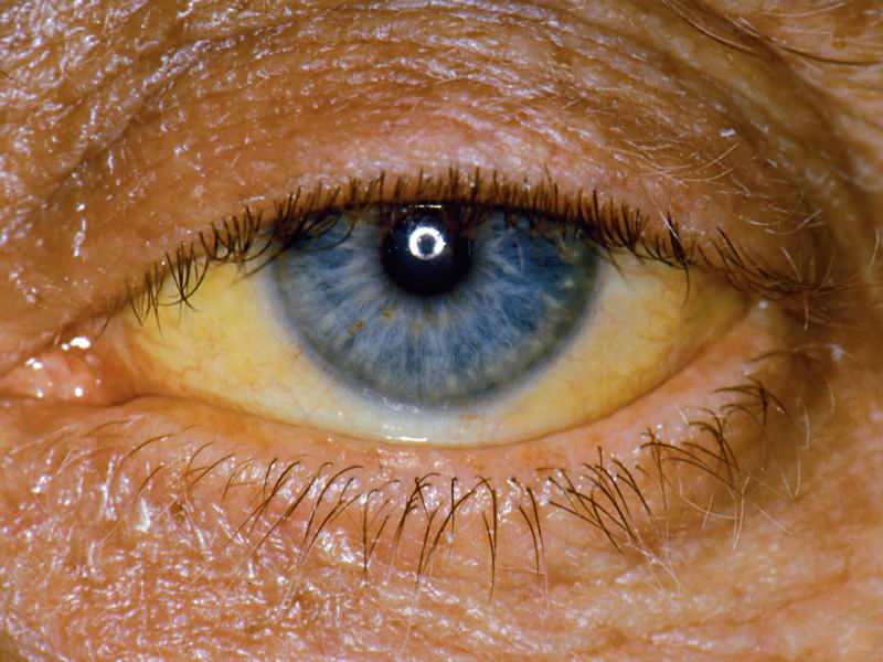 wysokość na poziomie bilirubiny powoduje zażółcenie oczu i skóry
