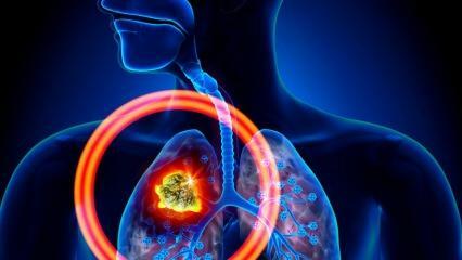 Jakie są objawy raka płuc? Czy istnieje lekarstwo na raka płuc?
