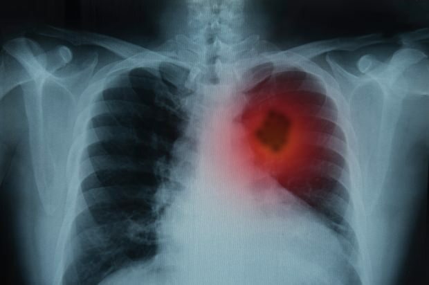 Jakie są objawy raka płuc? Czy istnieje leczenie raka płuc? Aby zapobiec rakowi płuc ...