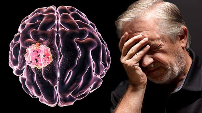 Tkanka utworzona w mózgu w wyniku rozerwania struktur komórkowych nazywana jest guzem.