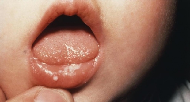 Jak boli usta u dzieci