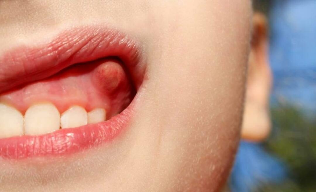 Dlaczego ropień zęba i jakie są objawy? Ropień zęba, jak się go leczy?