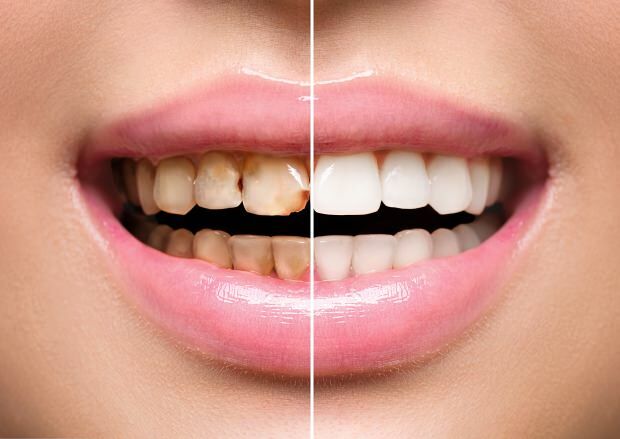 W wyniku niezdrowego odżywiania występują zarówno przebarwienia, jak i utrata zębów
