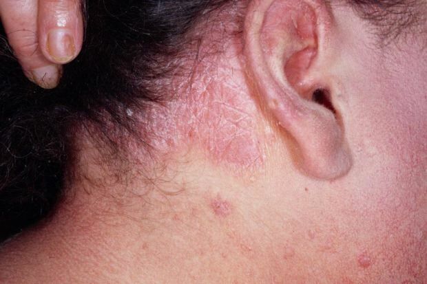 Jakie są objawy łojotokowego zapalenia skóry i kto się pojawia? Pokarmy, które wywołują chorobę