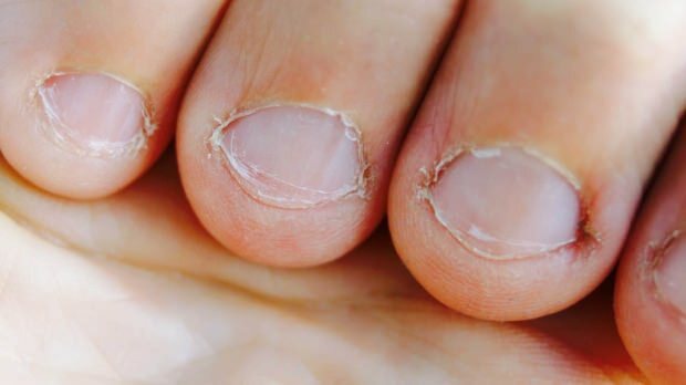 Co to jest choroba odżywiania paznokci? Jakie choroby powoduje jedzenie paznokci?