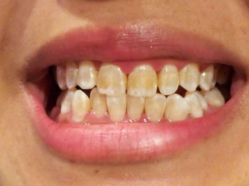 obraz zęba osoby, której zęby zaczynają ciemnieć