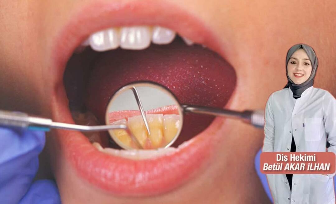 Co należy zrobić, aby uniknąć kamienia nazębnego? Jakie są korzyści ze skalingu zębów?