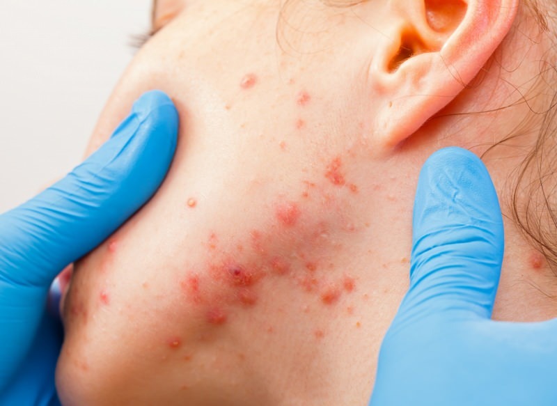 wirus powoduje pęcherze na powierzchni skóry